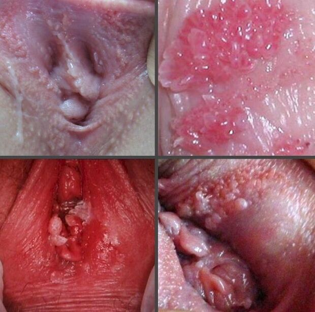 Vajinadaki papillomların yakından görünümü