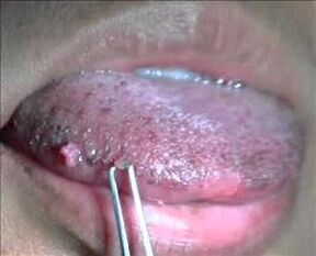 dilde insan papilloma virüsü